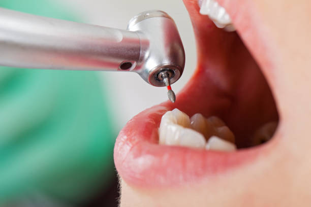 Best Emergency Tooth Extraction in Beulaville, NC